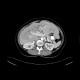 Liver metastases, carcinoid: CT - Computed tomography
