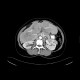 Liver metastases, carcinoid: CT - Computed tomography