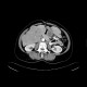 Liver metastases, carcinoid: CT - Computed tomography