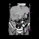 Liver metastases, carcinoid: CT - Computed tomography