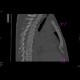 Myelofibrosis: CT - Computed tomography