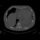 Myelofibrosis: CT - Computed tomography