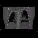 Myelofibrosis: CT - Computed tomography