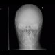 Multiple myeloma: X-ray - Plain radiograph