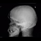 Multiple myeloma: X-ray - Plain radiograph