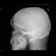 Multiple myeloma: X-ray - Plain radiograph