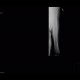 Multiple myeloma: X-ray - Plain radiograph