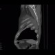 Multiple myeloma: CT - Computed tomography
