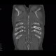 Multiple myeloma: CT - Computed tomography