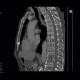 Multiple myeloma: CT - Computed tomography