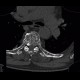 Skeletal changes in myeloma, thoracic spine and ribs: CT - Computed tomography
