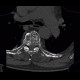 Skeletal changes in myeloma, thoracic spine and ribs: CT - Computed tomography
