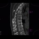Skeletal changes in myeloma, thoracic spine and ribs: CT - Computed tomography