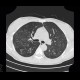 Fungal infection of lung, mycosis: CT - Computed tomography