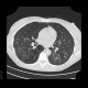 Fungal infection of lung, mycosis: CT - Computed tomography