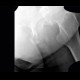 Myositis ossificans, ossifying tendon, adductor magnus, tuberosity of ischium: X-ray - Plain radiograph