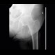 Myositis ossificans, ossifying tendon, adductor magnus, tuberosity of ischium: X-ray - Plain radiograph