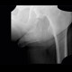 Myositis ossificans, ossifying tendon, adductor magnus, tuberosity of ischium: X-ray - Plain radiograph