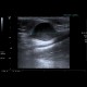 Myxofibrosarcoma of arm: US - Ultrasound