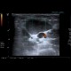 Myxofibrosarcoma of arm: US - Ultrasound