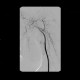 Myxofibrosarcoma of arm: AG - Angiography