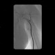 Myxofibrosarcoma of arm: AG - Angiography