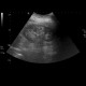 Nephrocalcinosis, calcification of papilla: US - Ultrasound