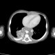 Neuroblastoma, mediastinal neuroblastoma: CT - Computed tomography