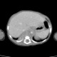 Neuroblastoma, mediastinal neuroblastoma: CT - Computed tomography