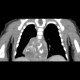 Neuroblastoma, mediastinal neuroblastoma: CT - Computed tomography