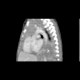 Neuroblastoma, mediastinal neuroblastoma: CT - Computed tomography