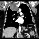 Neurofibroma of the thorax: CT - Computed tomography