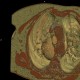 Neurofibroma of the thorax: CT - Computed tomography