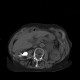 Casting renal stones: CT - Computed tomography