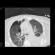 Nasogastric tube in pleural cavity, pneumothorax, pleural effusion: CT - Computed tomography