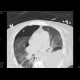 Nasogastric tube in pleural cavity, pneumothorax, pleural effusion: CT - Computed tomography