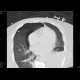 Nasogastric tube in pleural cavity, pneumothorax, pleural effusion: CT - Computed tomography