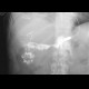 Biliary T-drain, drain into liver abscess, fistulography: RF - Fluoroscopy