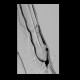 Shunt stenosis, angioplasty, native shunt: AG - Angiography