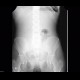 Air in bowel wall: X-ray - Plain radiograph