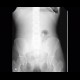 Intramural gas in bowel wall on abdominal radiograph: X-ray - Plain radiograph