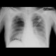 Lung bilobectomy, residual cavity, remaining lobe not expanded: X-ray - Plain radiograph