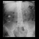 Nephrolithiasis, kidney stones, calcified splenic artery, Chinese dragon sign: X-ray - Plain radiograph