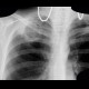 Cavity in the lung, cavern, TBC, tuberculosis: X-ray - Plain radiograph