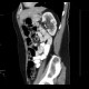 Hydronephrosis, grade II, bilateral, follow-up: CT - Computed tomography