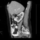 Hydronephrosis, grade II, bilateral, follow-up: CT - Computed tomography