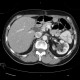 Hydronephrosis, grade II, bilateral, follow-up: CT - Computed tomography