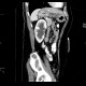 Hydronephrosis, grade I, bilateral, initial: CT - Computed tomography