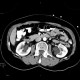 Hydronephrosis, grade I, bilateral, initial: CT - Computed tomography