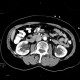 Hydronephrosis, grade I, bilateral, initial: CT - Computed tomography